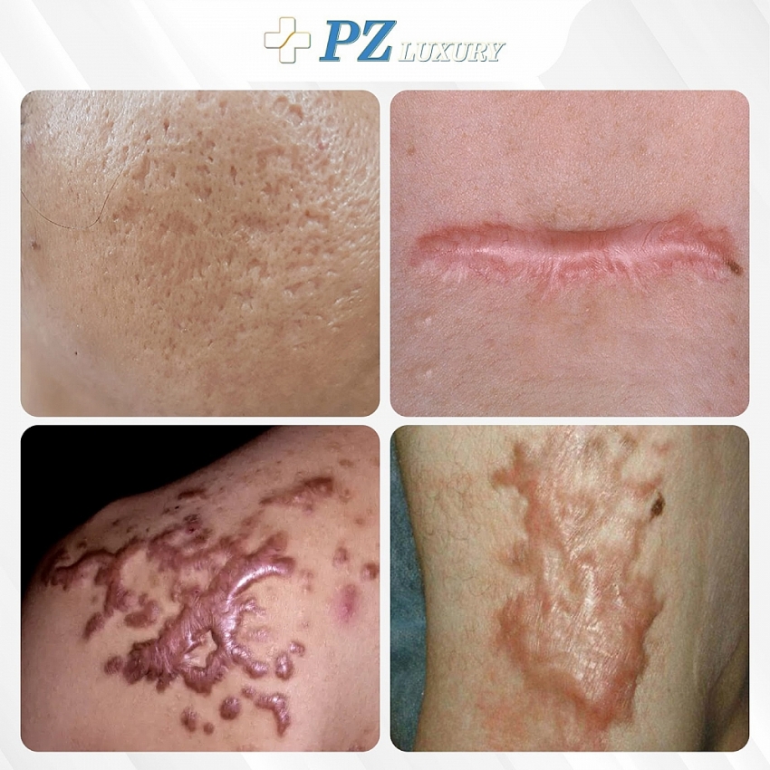 Làm thế nào để trị sẹo an toàn, dứt điểm lo âu? Làm thế nào để trị sẹo an toàn, dứt điểm lo âu?