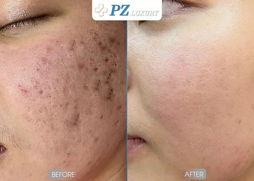 Làm thế nào để trị sẹo an toàn, dứt điểm lo âu? Làm thế nào để trị sẹo an toàn, dứt điểm lo âu?