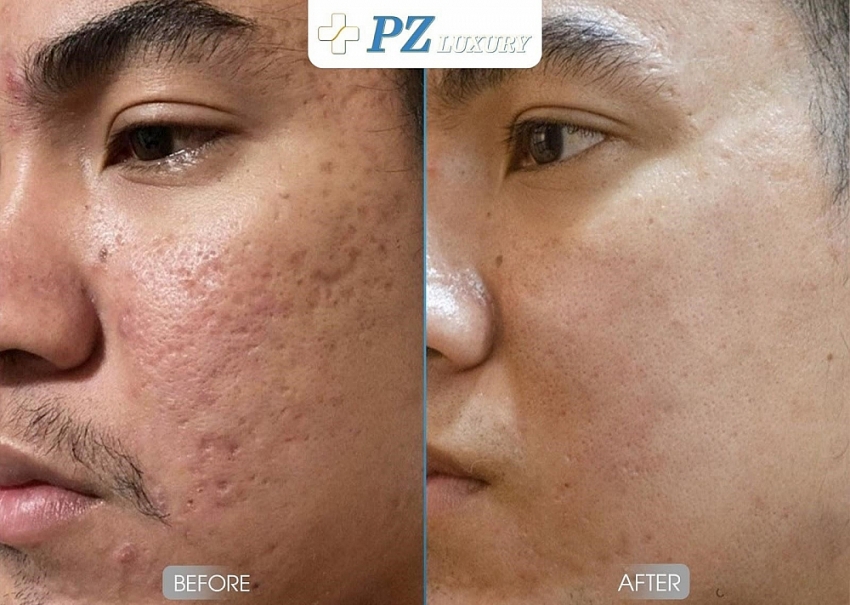 Làm thế nào để trị sẹo an toàn, dứt điểm lo âu? Làm thế nào để trị sẹo an toàn, dứt điểm lo âu?